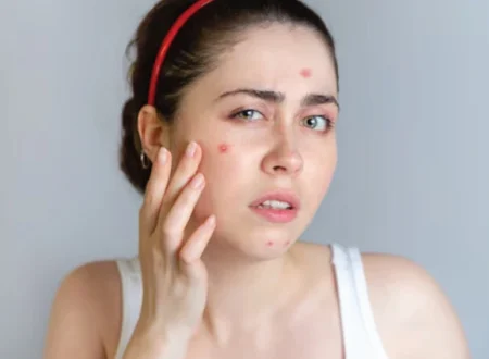 Struggling With Blemishes And Acne? Follow This Easy Skincare Routine For Clear Skin