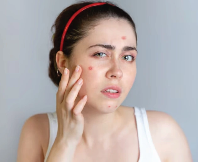 Struggling With Blemishes And Acne? Follow This Easy Skincare Routine For Clear Skin